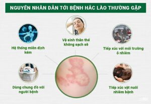 nguyên nhân bị bệnh hắc lào