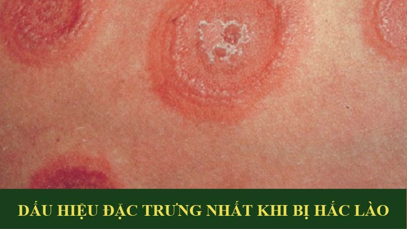 bệnh hắc lào có lây không