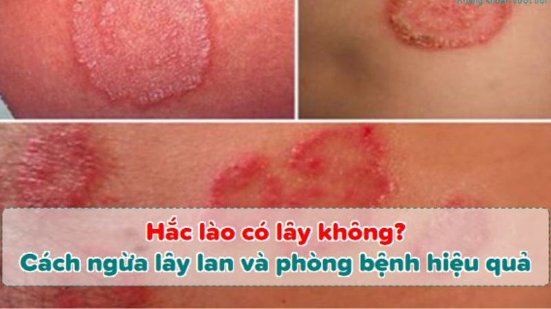 bệnh hắc lào có lây không