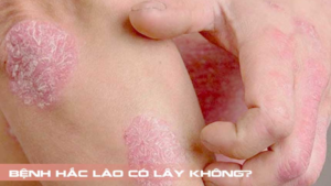 bệnh hắc lào có lây không