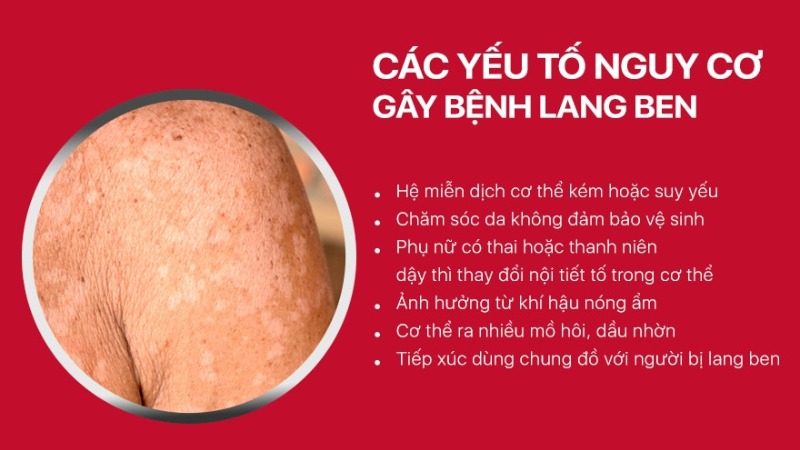 bệnh lang beng hắc lào