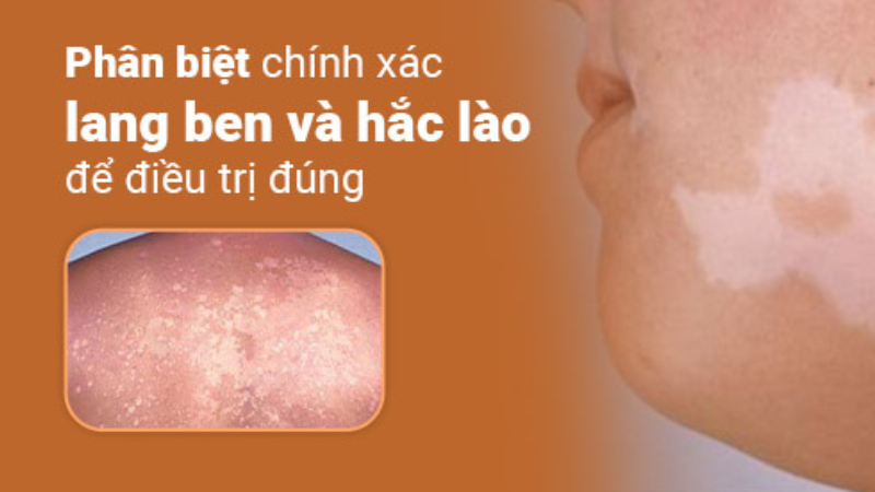 bệnh lang beng hắc lào