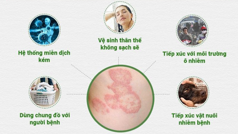 cách phòng tránh bệnh hắc lào