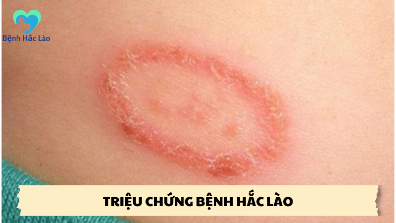 triệu chứng bệnh hắc lào