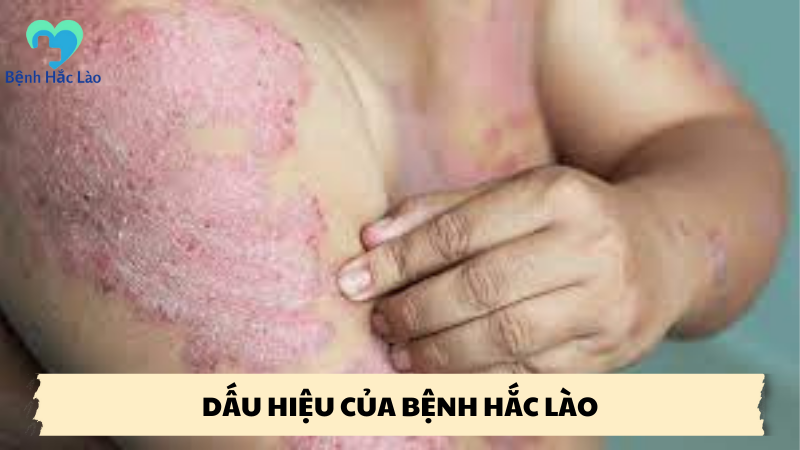 dấu hiệu của bệnh hắc lào