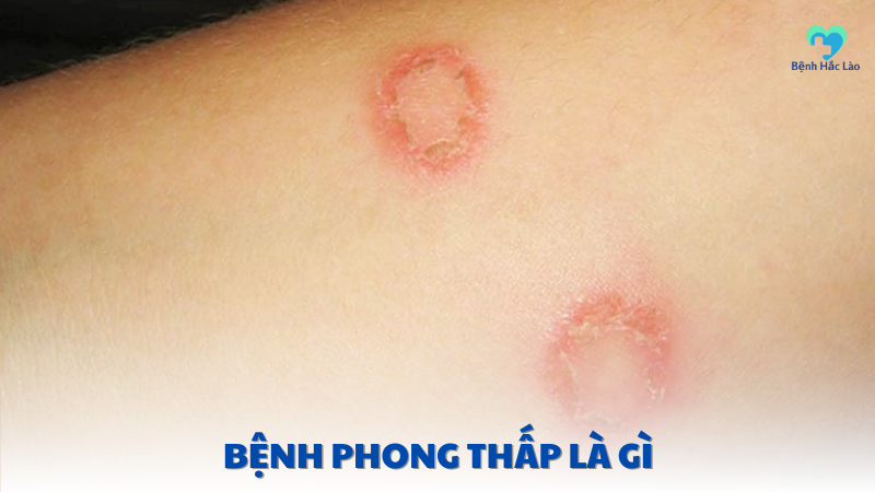 hình ảnh bệnh hắc lào