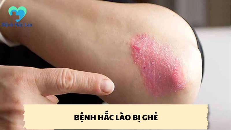 bệnh hắc lào bị ghẻ