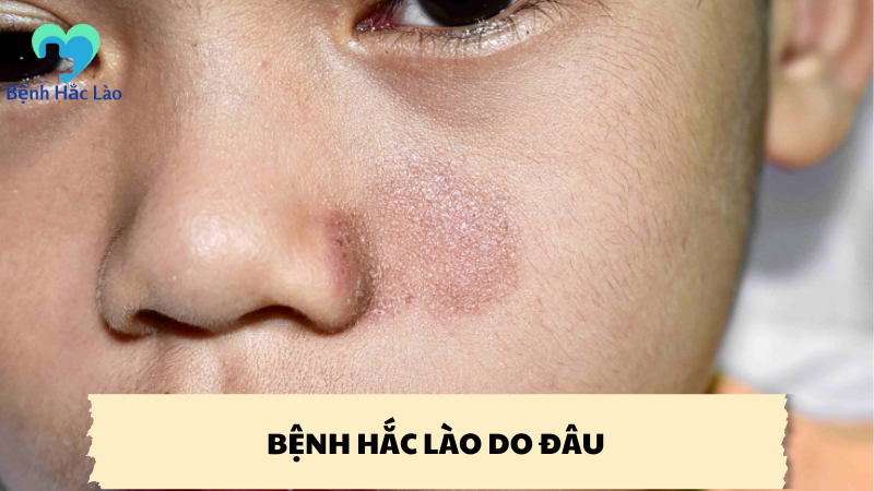 bệnh hắc lào do đâu