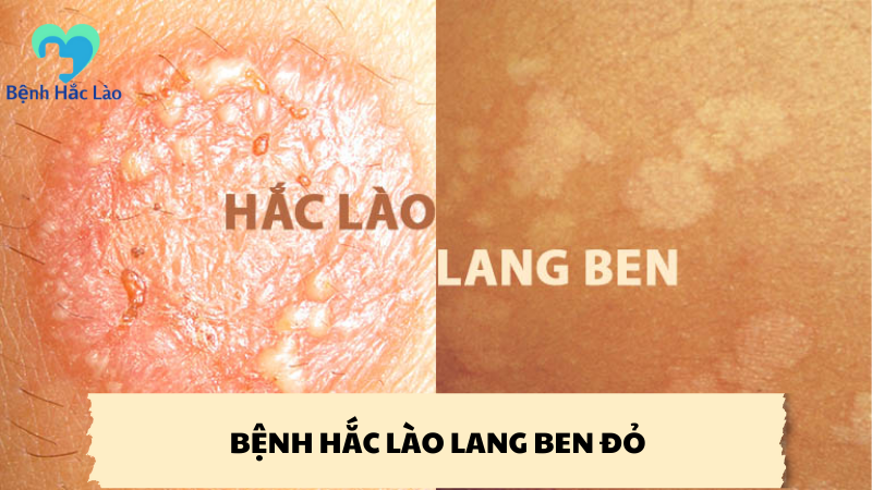 bệnh hắc lào lang beng đỏ